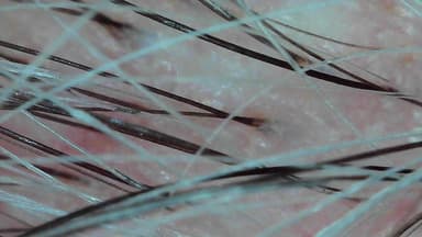 Magnified scalp capture, dense hair