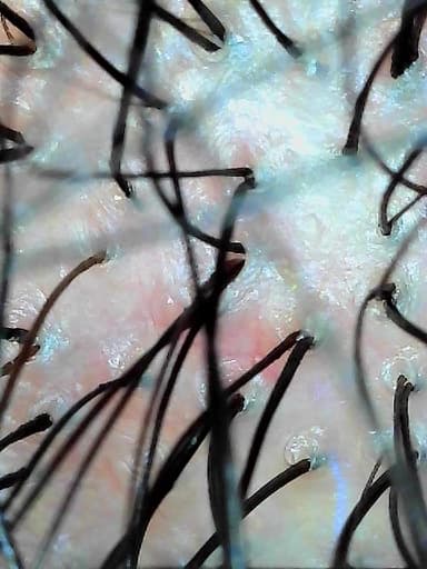 Magnified scalp capture, hair follicles at the root