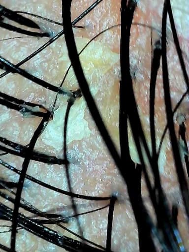 Magnified scalp capture, buildup around the follicles